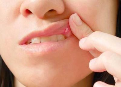 درمان های خانگی برای درمان آفت دهان
