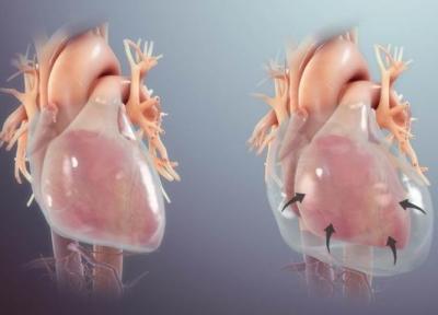 افیوژن پریکارد یا آب آوردن فضای پرده قلب چرا ایجاد می شود و چطور تشخیص داده می شود؟